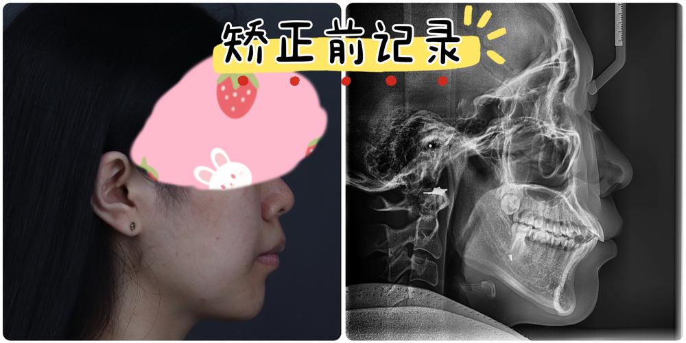 如何有效旋转牙齿？矫正牙齿的旋转方法有哪些？-图1