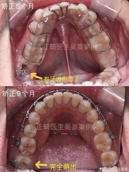 如何有效旋转牙齿？矫正牙齿的旋转方法有哪些？-图2