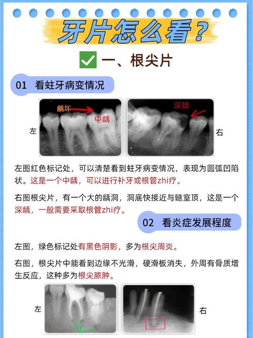 口腔拍片常用方法有哪些？各自适用什么情况？-图3
