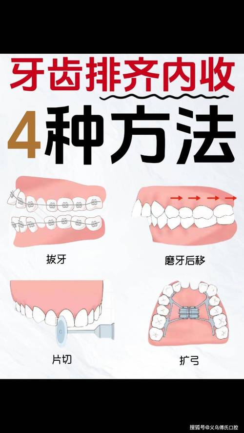 矫正牙齿的方法该怎么选才适合自己?-图3 矫正牙齿的方法该怎么选才适合自己?-图3