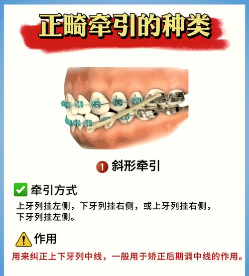 牙齿牵引的方法-图3