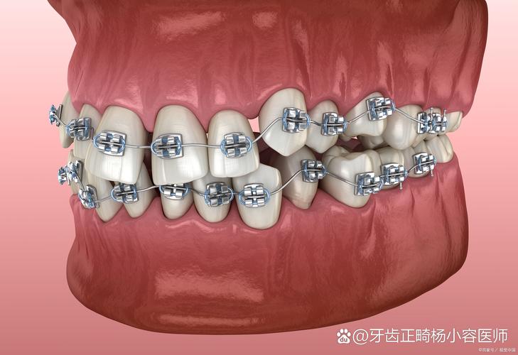 深覆合合并TMD,正畸治疗有效果吗?-图3 深覆合合并TMD,正畸治疗有效果吗?-图3