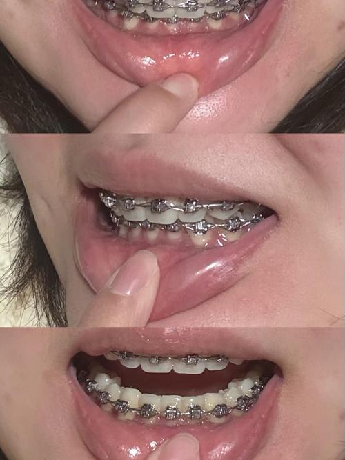 深覆合合并TMD,正畸治疗有效果吗?-图2 深覆合合并TMD,正畸治疗有效果吗?-图2