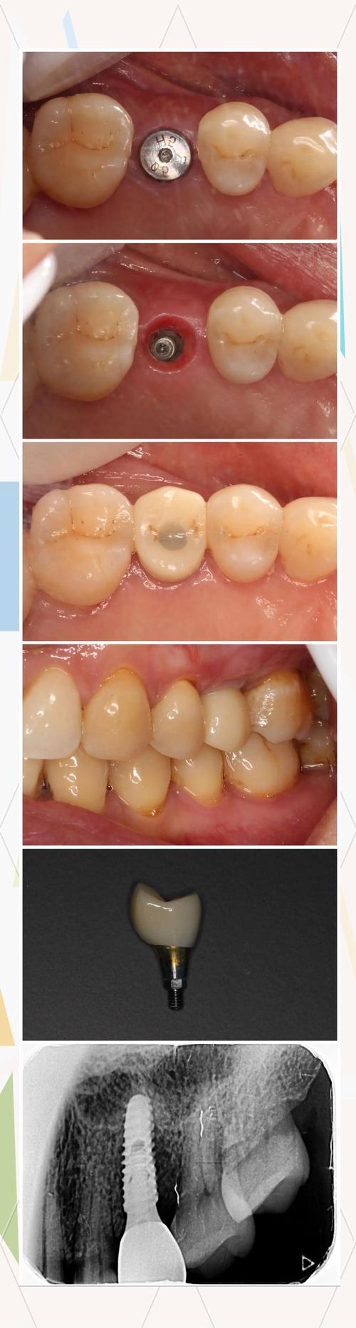 种牙二期术后疼痛是什么原因？如何缓解？-图2