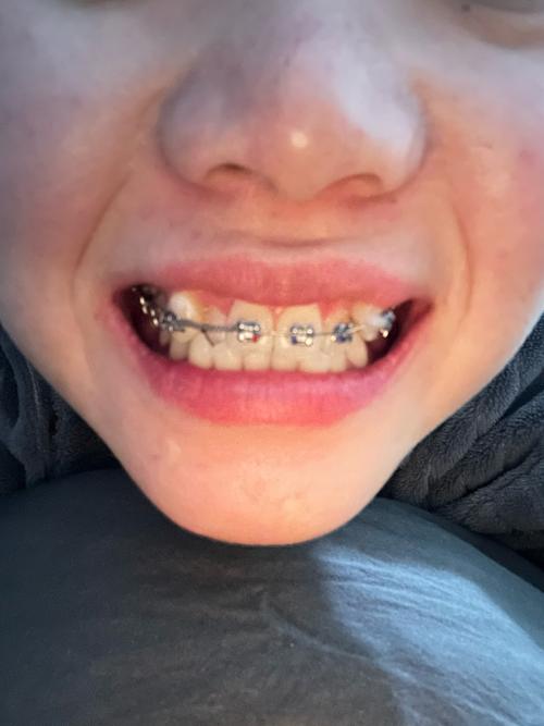 口腔正畸中口内拍照视频有何关键作用？-图2