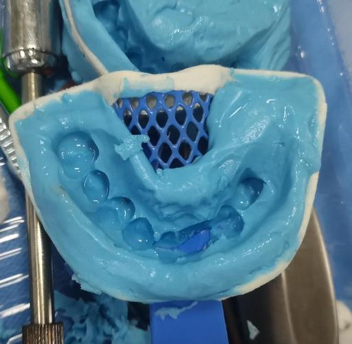 种牙取模一般需要多长时间？-图2