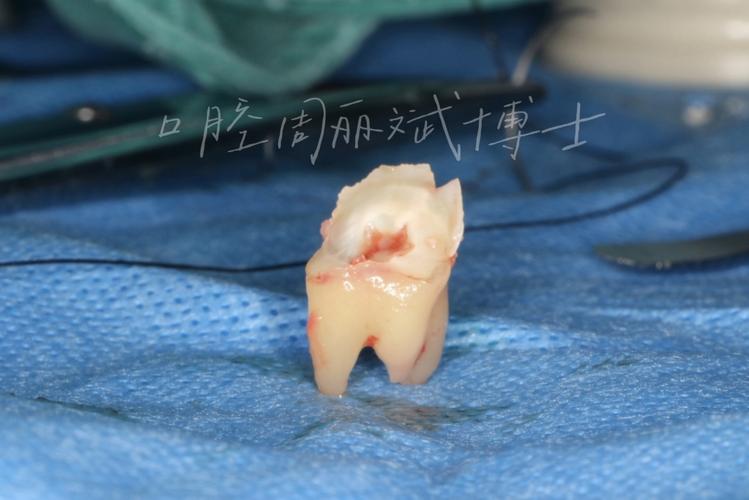 正畸后智齿突然萌出,是巧合还是另有原因?-图2 正畸后智齿突然萌出,是巧合还是另有原因?-图2