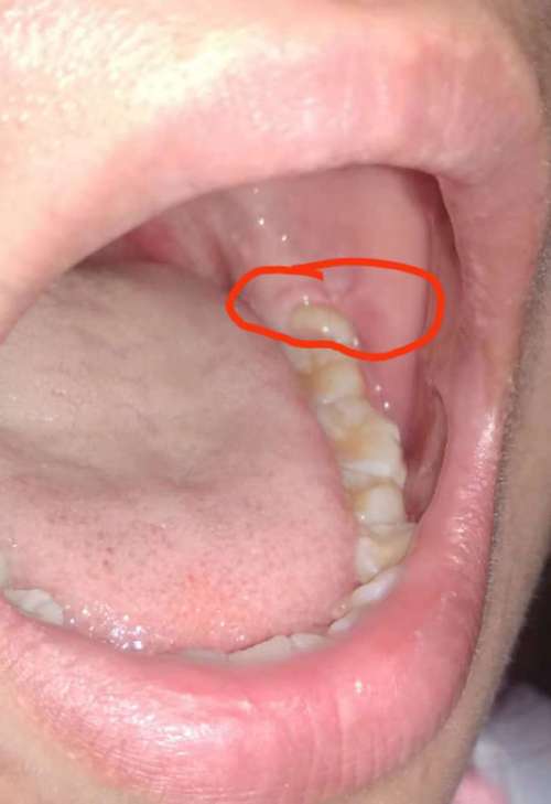 正畸后智齿突然萌出,是巧合还是另有原因?-图1 正畸后智齿突然萌出,是巧合还是另有原因?-图1