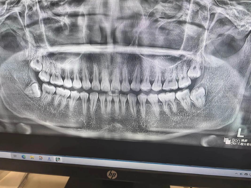 正畸后智齿突然萌出,是巧合还是另有原因?-图3 正畸后智齿突然萌出,是巧合还是另有原因?-图3