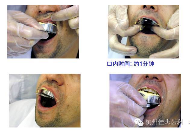 印模的灌注方法-图1