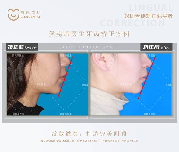 澳洲正畸Dr T的矫正效果如何？-图2