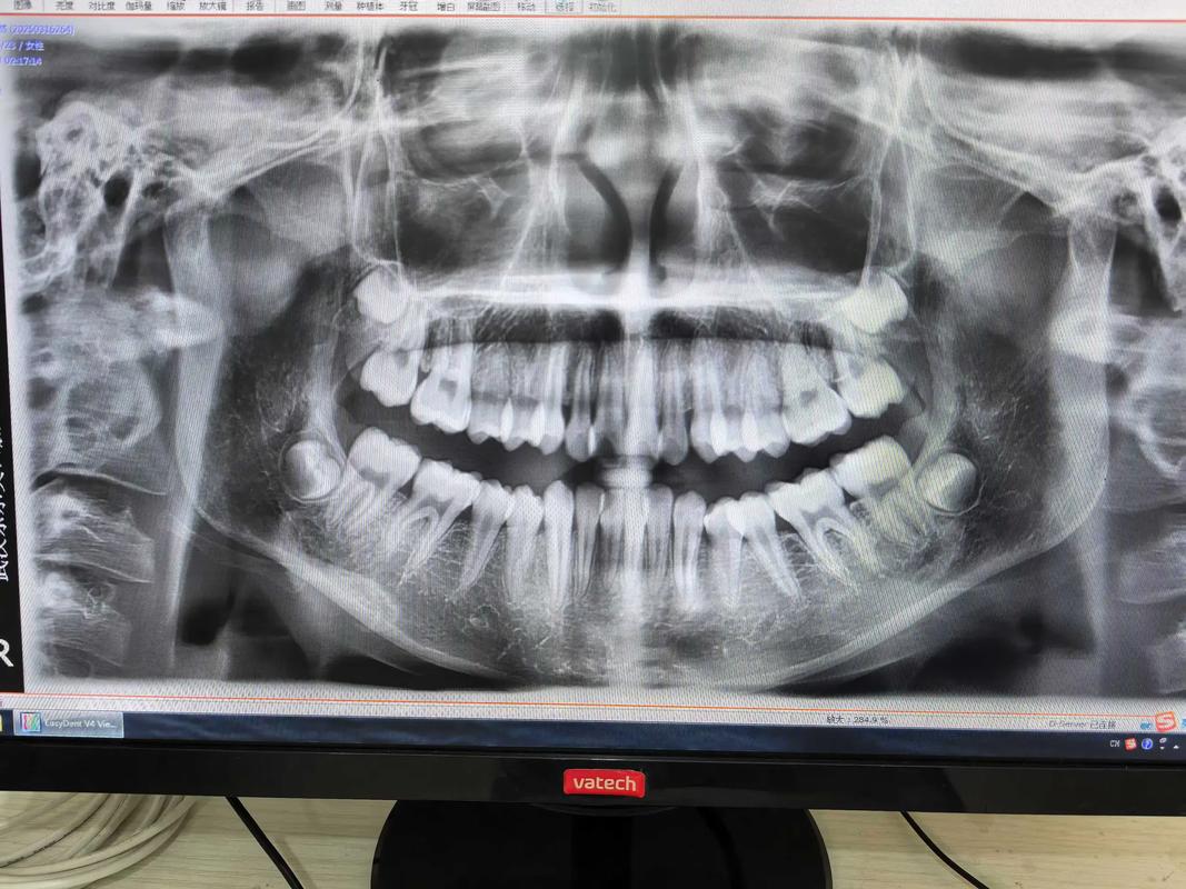 澳洲正畸Dr T的矫正效果如何？-图3