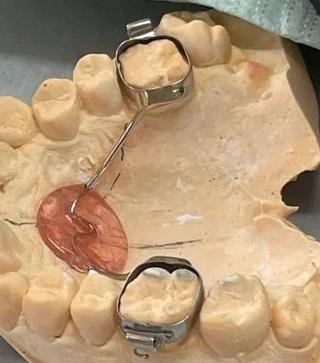 nance弓正畸图片能展示哪些具体矫正细节？-图3