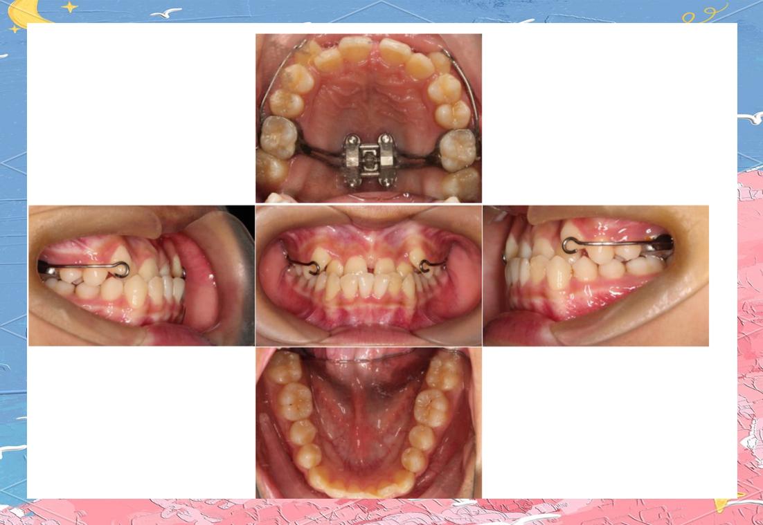 正畸弱支抗方法如何高效实现精准矫治？-图3