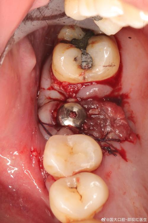 种牙植骨后牙龈肿是什么原因引起的？-图1