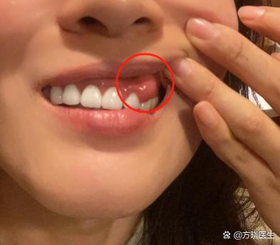 种牙植骨后牙龈肿是什么原因引起的？-图3