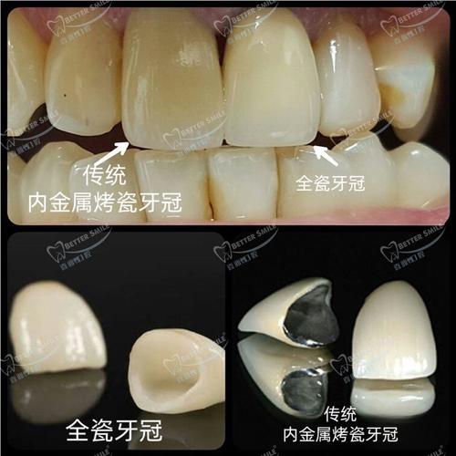 种牙与全瓷牙有何区别？哪种更适合你？-图3