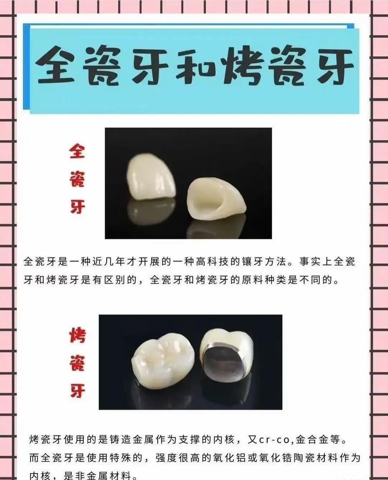 种牙与全瓷牙有何区别？哪种更适合你？-图1