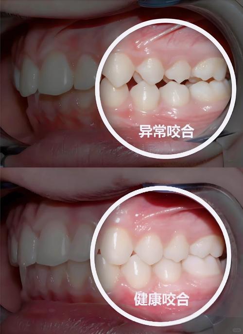 确定咬合的方法-图1