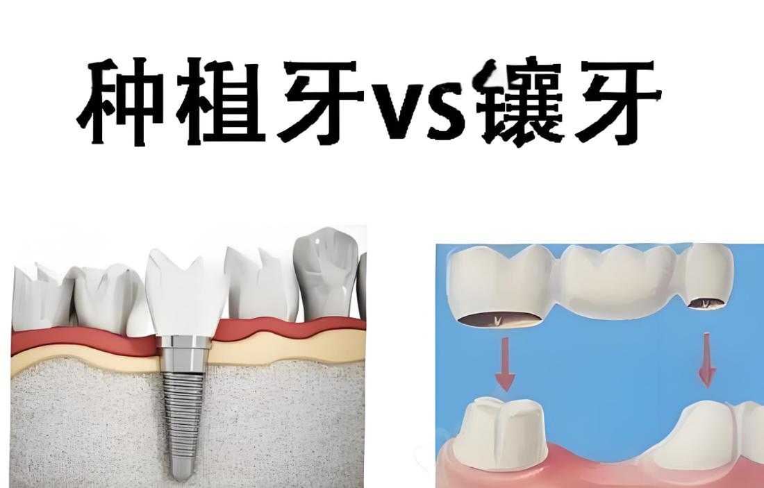 镶牙和种牙哪个疼-图3