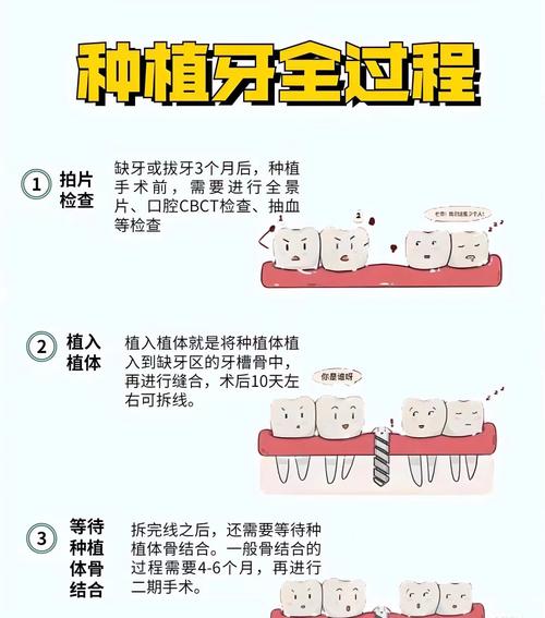 种牙周期多少时间-图2