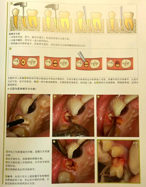 前牙拔除的正确方法有哪些操作要点？-图2