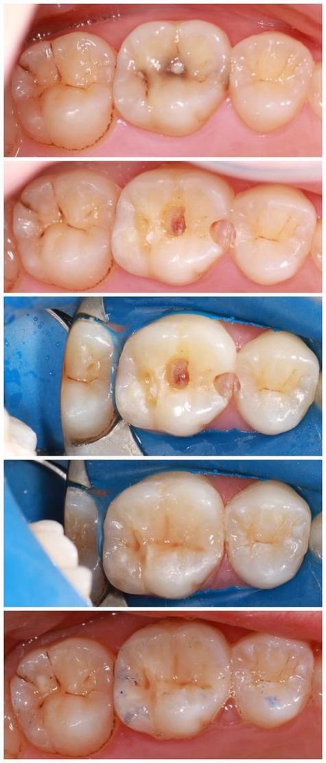 牙齿补洞的方法-图2