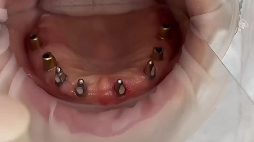 全口种牙过程视频能看清哪些种植关键步骤？-图2