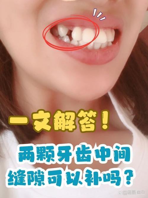 牙缝太小能种牙吗-图3