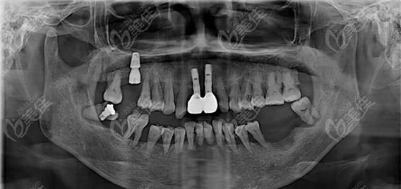 种牙前需要拍片吗-图3