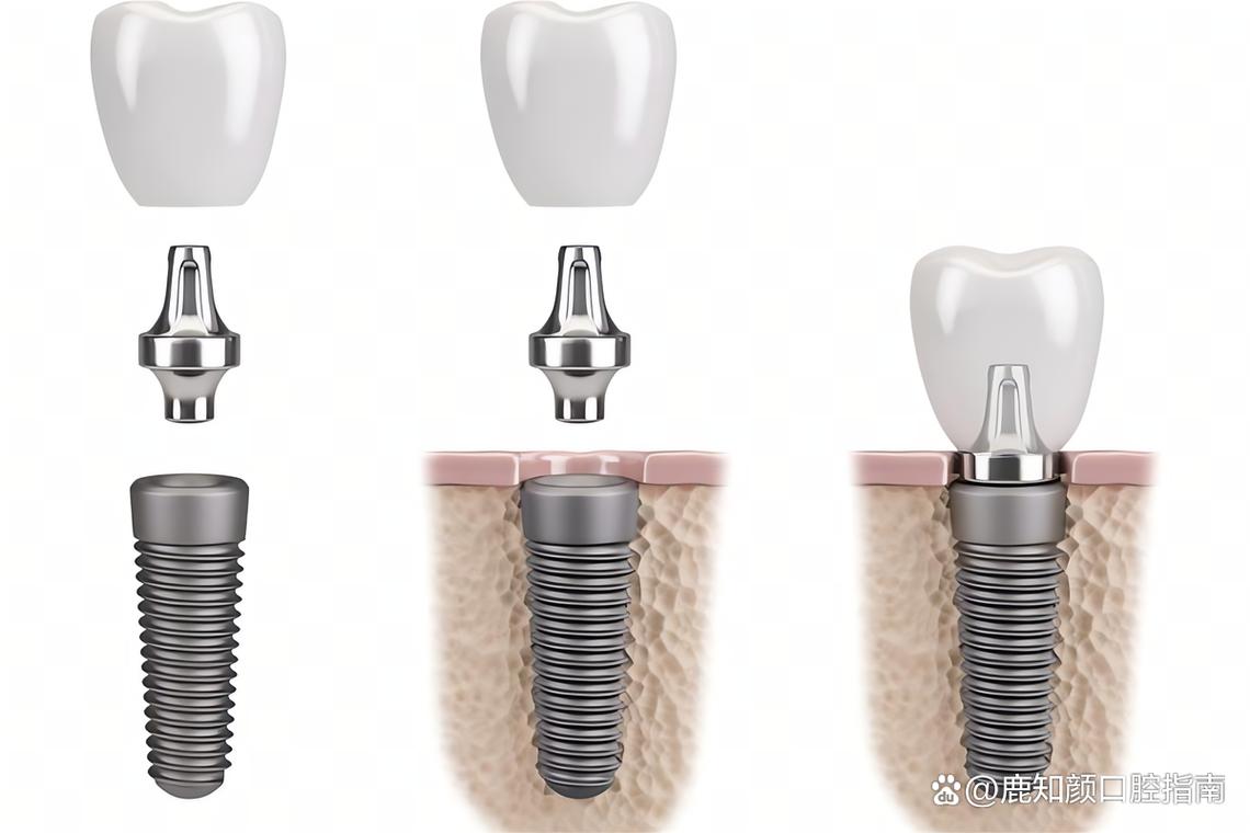 广州种牙那哪里好-图1