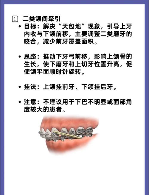 正畸矫治的方法-图3 正畸矫治的方法-图3