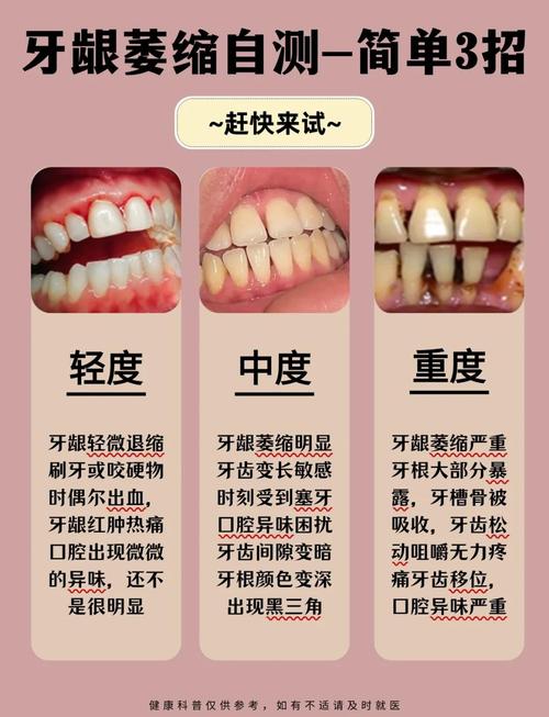 牙龈萎缩可以种牙-图1 牙龈萎缩可以种牙-图1