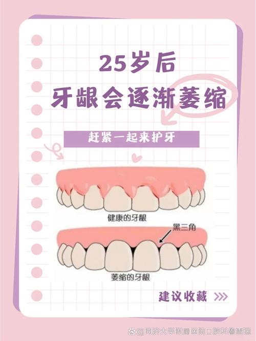 牙龈萎缩可以种牙-图3 牙龈萎缩可以种牙-图3