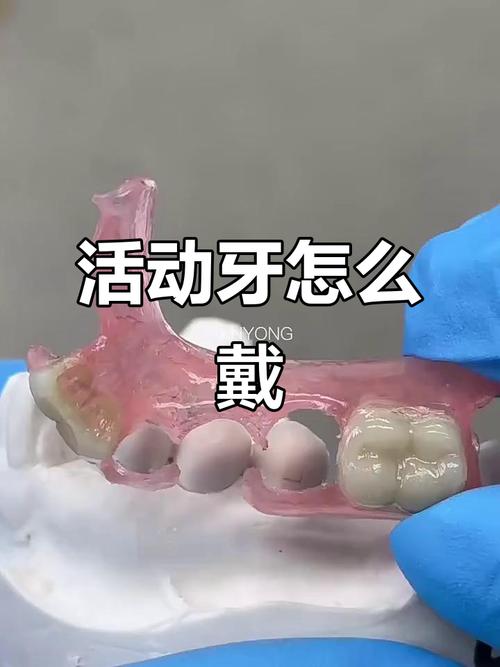 种牙临时牙冠戴法-图3