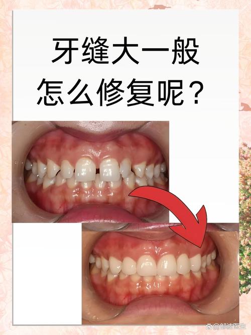 牙缝大修补方法-图3