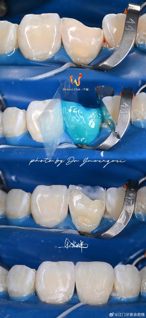 树脂补牙后正畸脱落，是材料影响吗？-图2