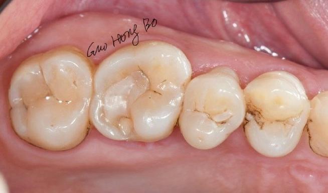 树脂补牙后正畸脱落，是材料影响吗？-图3