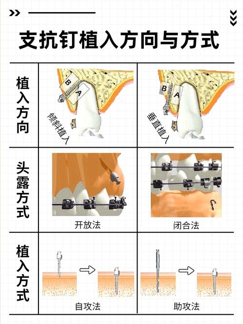 支抗设计与方法-图1