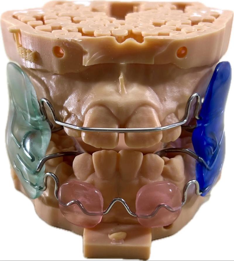 正畸Frank是什么？矫正牙齿的Frank技术是什么？-图1