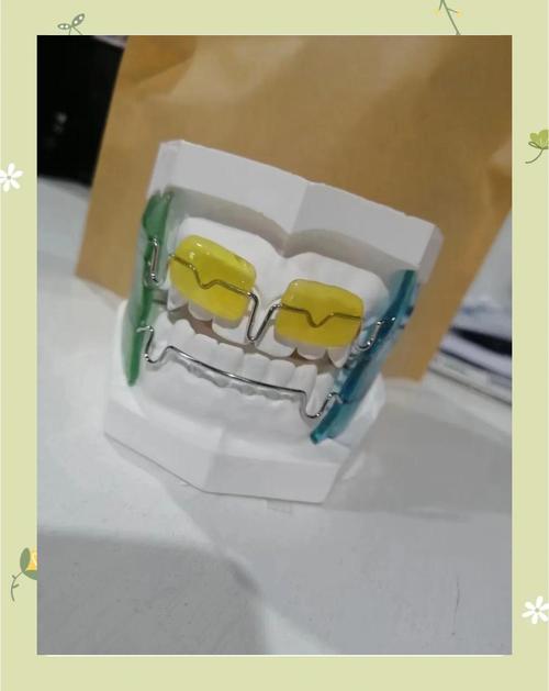 正畸Frank是什么？矫正牙齿的Frank技术是什么？-图2