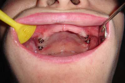 没有真牙的情况下,是否还能进行种植牙治疗呢?-图2 没有真牙的情况下,是否还能进行种植牙治疗呢?-图2