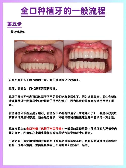 种植牙治疗方法-图1