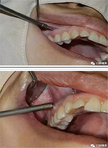 Ormco正畸种植钉有何独特优势与应用价值？-图2