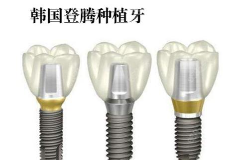 诺贝尔种牙多少钱-图1 诺贝尔种牙多少钱-图1