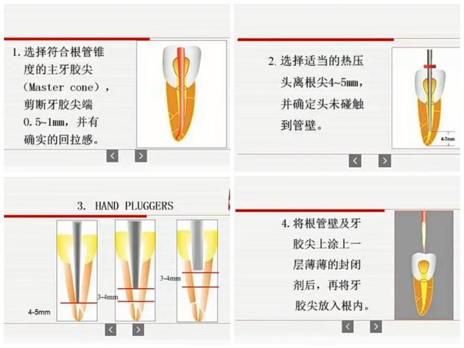 牙胶尖充填方法的关键步骤有哪些？-图3