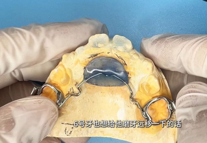 DamonQ正畸效果如何？牙齿矫正有哪些独特优势？-图3