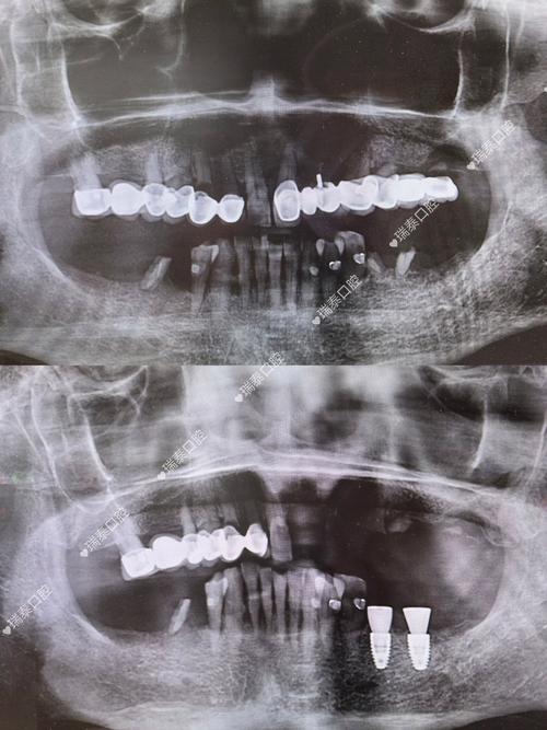 种牙愈合帽是什么？种植牙过程必备吗？-图3