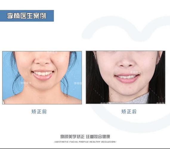 口腔正畸正畸二类骨性-图2