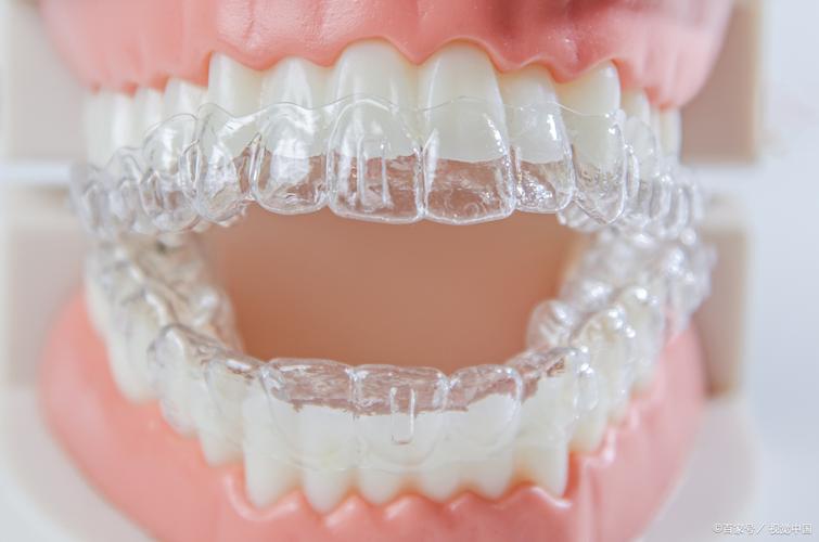 edgewise正畸，矫正牙齿的独特优势是什么？-图1